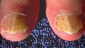 стригущий лишай на ногтях, онихомикоз – поражение ногтей грибковой инфекцией